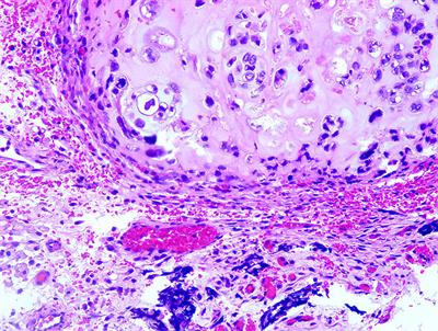 Case Report: Niraparib as Maintenance Therapy in A Patient With Ovarian Carcinosarcoma